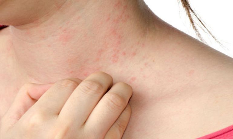 Allergiyaya qarşı üsul tapıldı