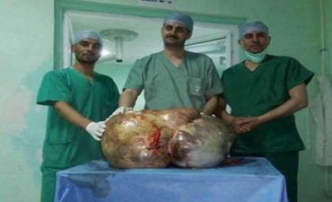 Xəstənin yumurtalığından 37 kq-lıq şiş çıxarıldı -